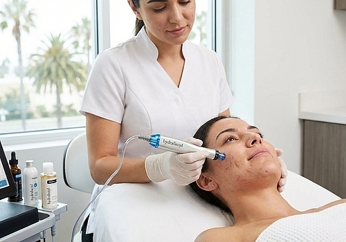 How HydraFacials Help Improve Acne Scars in Costa Mesa