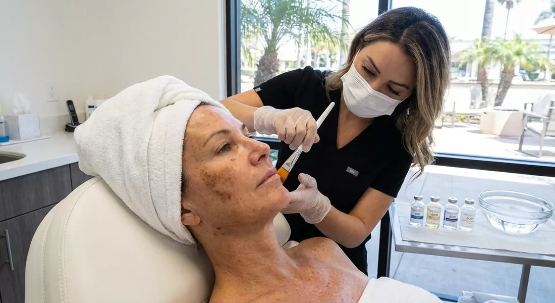 Can Chemical Peels Help Lighten Dark Spots in Costa Mesa?