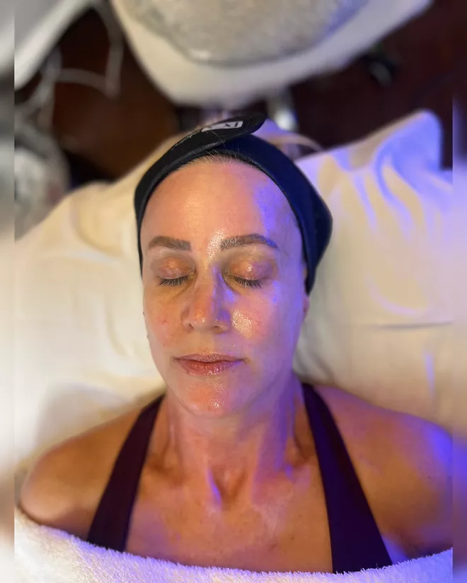 What to Expect During Your First Chemical Peel in Costa Mesa