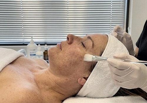 Chemical Peels in Mission Viejo for Uneven Skin Tone