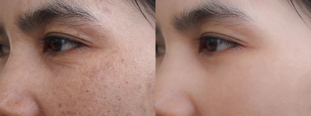 5 Advantages of Using Chemical Peels for Brown Spots