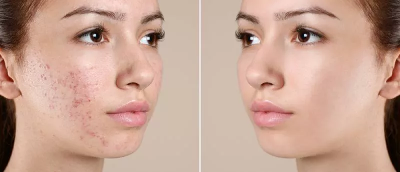 Microdermabrasion for Acne Scars: How it Helps Fade Blemishes and Smooth Skin